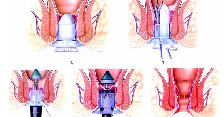 Male anal sphincter atrophy